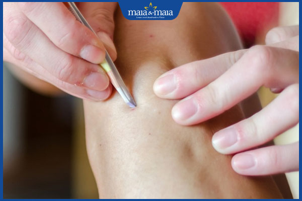 Nhổ lông chân tại nhà như thế nào? Rủi ro có thể gặp 2 thực hiện nhổ lông chân