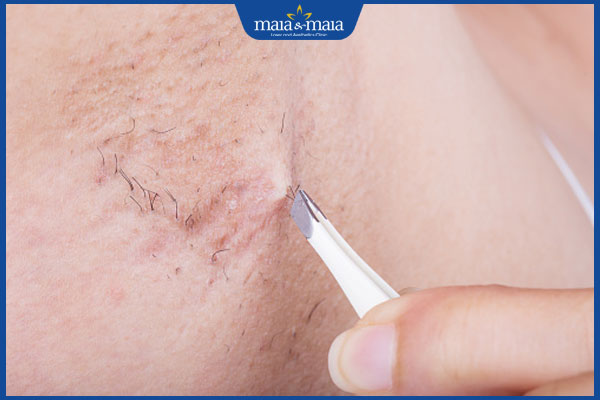 Nhổ lông nách và những rủi ro có thể gặp phải 2 thực hiện nhổ lông nách