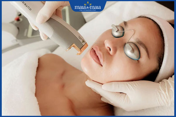 thực hiện triệt lông mặt bằng laser