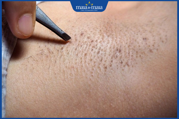 tiến hành nhổ lông nách