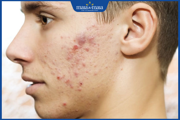 Da mặt sần sùi nhiều mụn do đâu? Cách xử lý dứt điểm 2 tình trạng da mặt sần sùi nhiều mụn