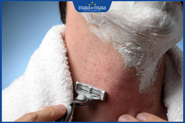 tình trạng da sau cạo râu