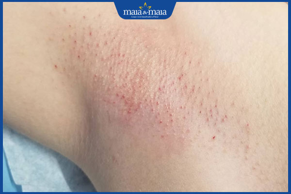 Wax lông có làm to lỗ chân lông? Gợi ý cách waxing an toàn 2 tình trạng da sau wax lông