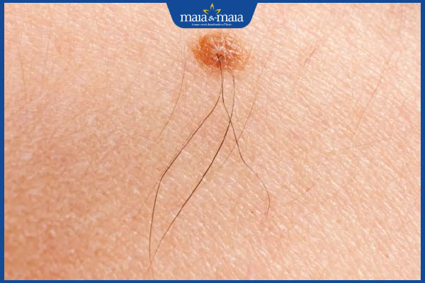 tình trạng lông mọc trên nốt ruồi