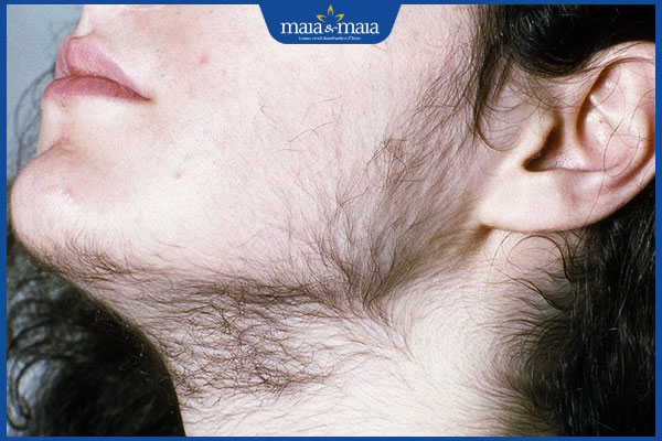 Rậm lông bất thường: Nguyên nhân và cách điều trị 2 tình trạng rậm lông bất thường