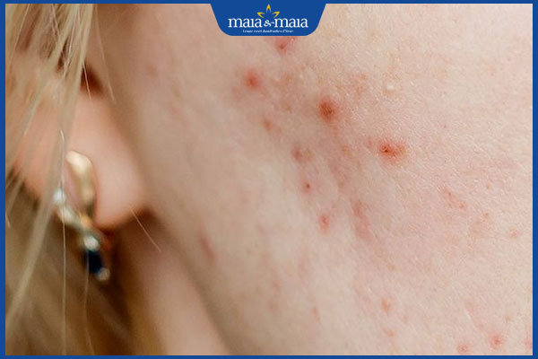 tình trạng thâm đỏ sau mụn