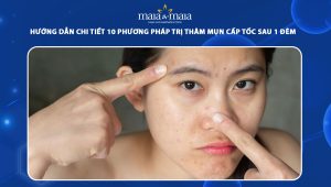 trị thâm mụn cấp tốc sau 1 đêm