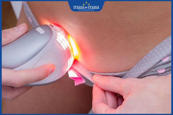 Triệt lông bikini bằng ánh sáng an toàn và hiệu quả cao 2 triệt lông ánh sáng ipl