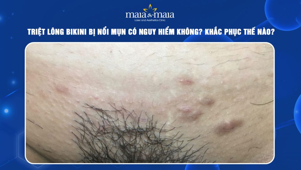 triệt lông bikini bị nổi mụn