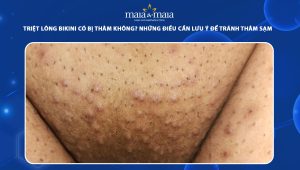 triệt lông bikini có bị thâm không