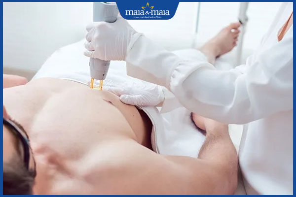triệt lông cho nam bằng laser