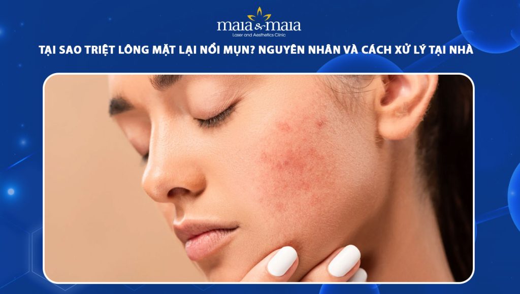 triệt lông mặt lại nổi mụn