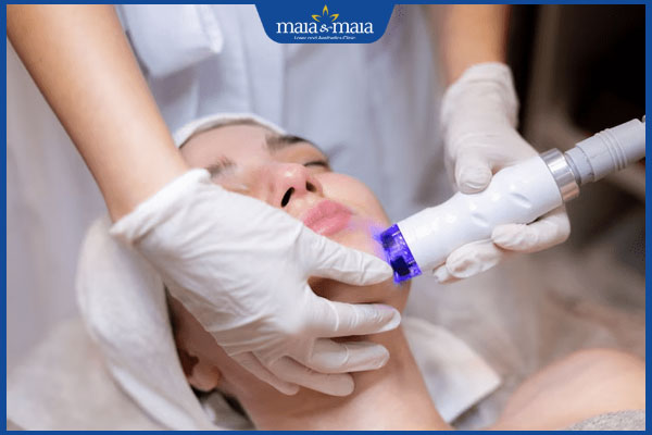 Có nên triệt lông mặt không? Cách triệt lông mặt an toàn 3 triệt lông mặt vùng cằm