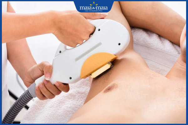 TOP 3 công nghệ triệt lông nách vĩnh viễn tốt nhất hiện nay 2 triệt lông nách nam