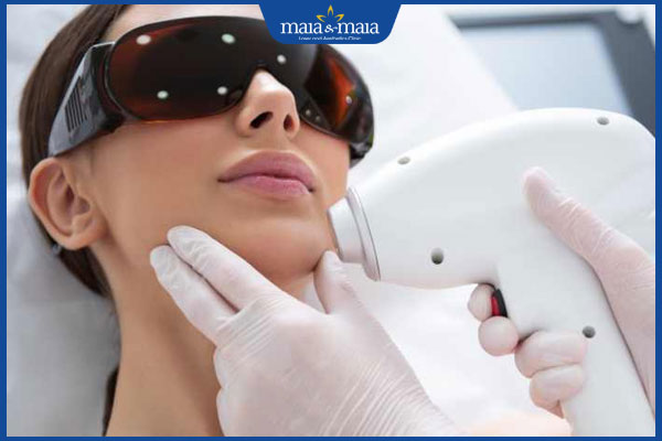 triệt ria mép không đau