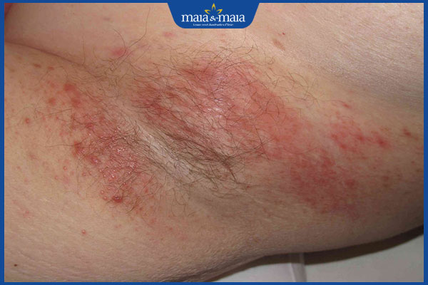 Đàn ông có nên cạo lông nách không? Giải pháp dọn lông nách vĩnh viễn 3 viêm nang lông sau cạo lông