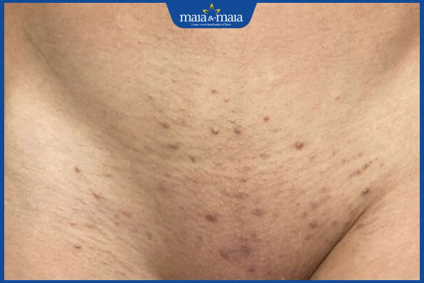 vùng kín bị thâm sạm sau triệt lông