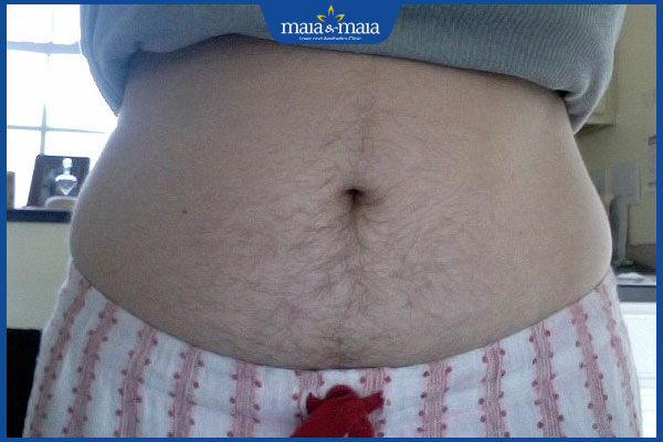 Con gái có lông bụng có sao không? Làm sao để cải thiện? 3 ảnh hưởng từ lông bụng ở nữ giới