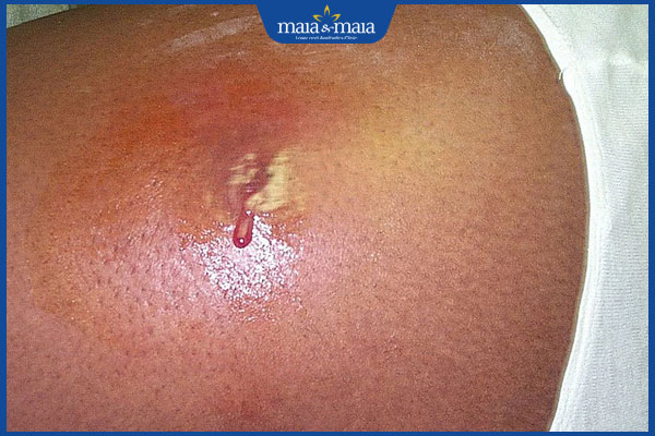 biến chứng khi lông mọc ngược