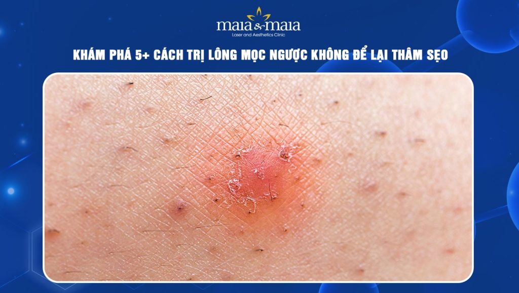 cách trị lông mọc ngược