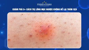 cách trị lông mọc ngược