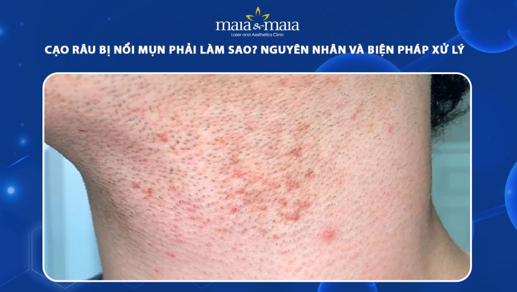 cạo râu bị nổi mụn
