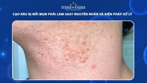 cạo râu bị nổi mụn
