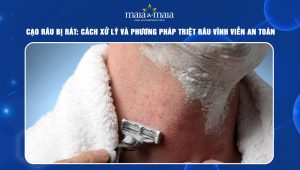 cạo râu bị rát