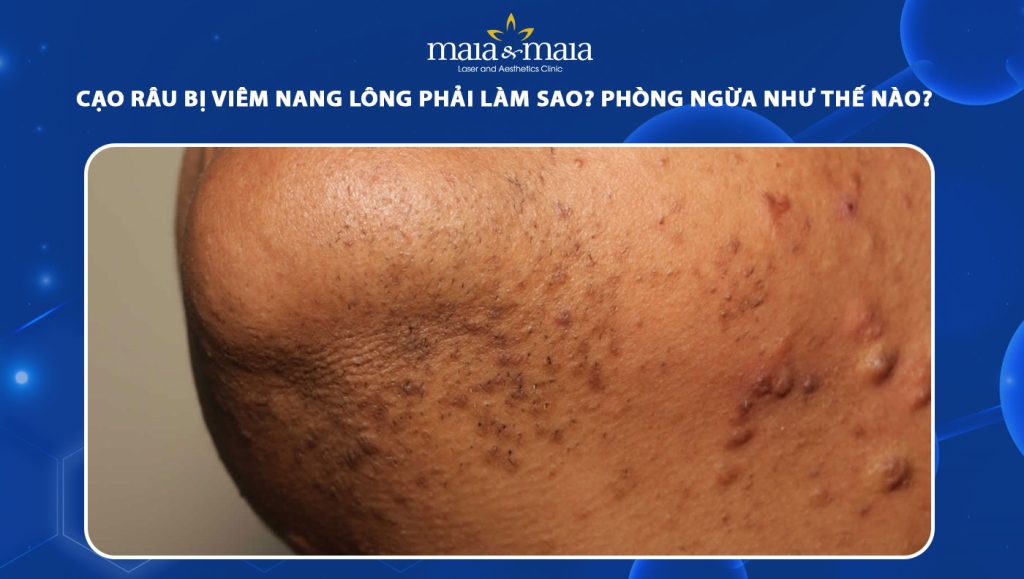 cạo râu bị viêm nang lông