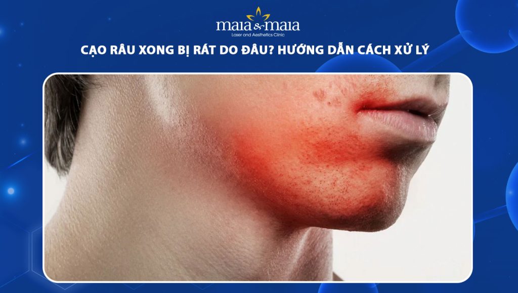 cạo râu xong bị rát