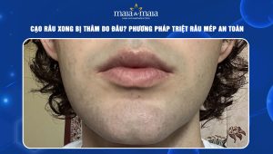 Cạo râu xong bị thâm