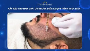 cấy râu