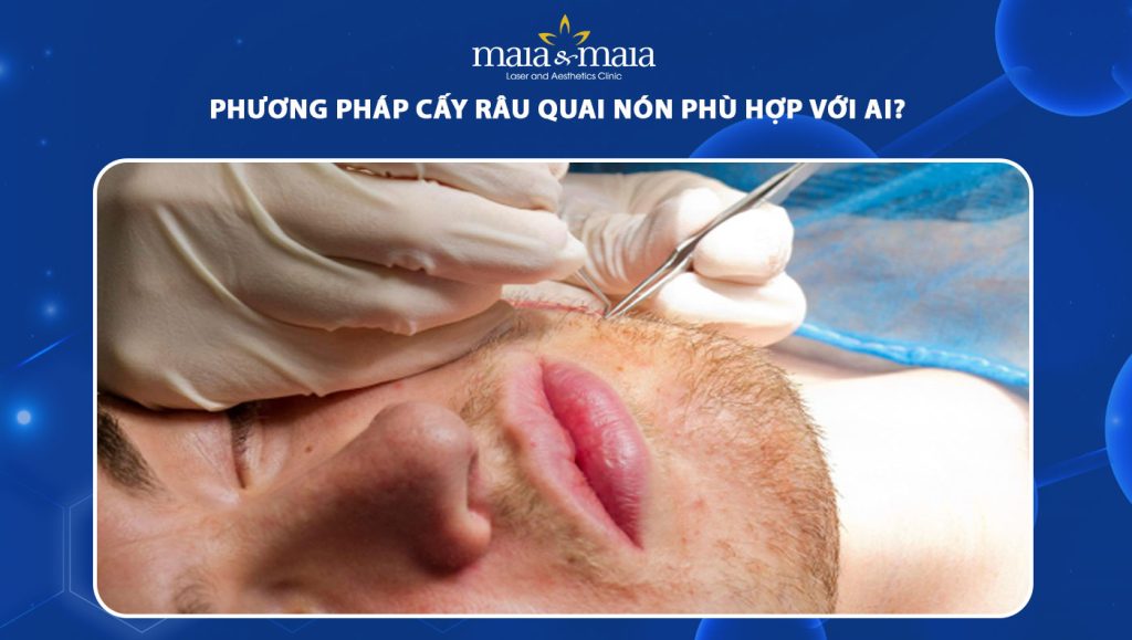 cấy râu quai nón