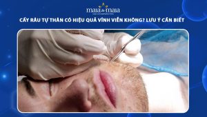 cấy râu tự thân