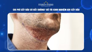 Chi phí cấy râu