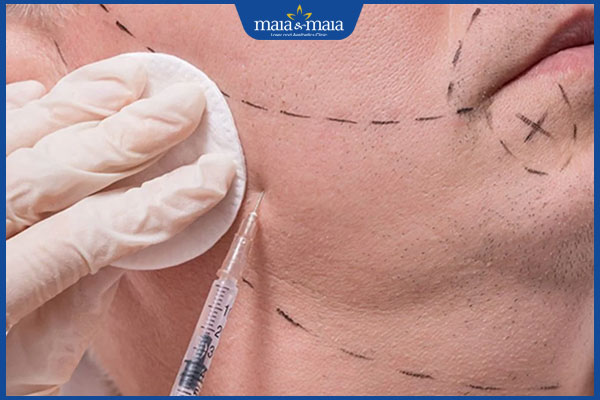 chuẩn bị cấy râu