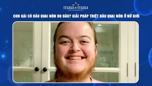 Con gái có râu quai nón