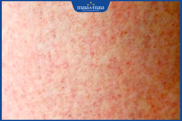 Tẩy lông bị rát phải làm sao? Giải pháp triệt lông an toàn 2 da đỏ rát