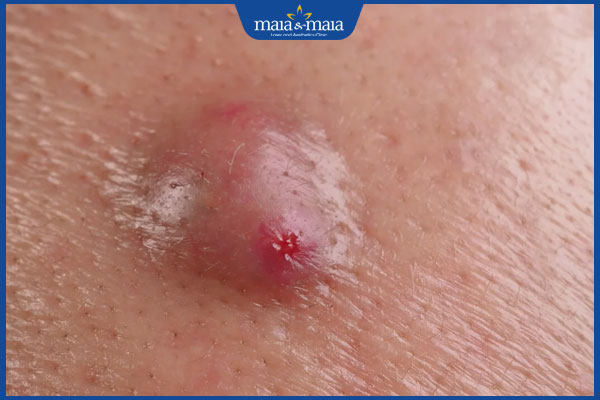 dấu hiệu lông mọc ngược