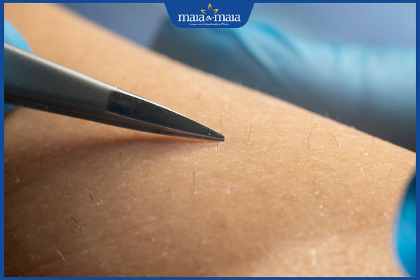 điện phân triệt lông