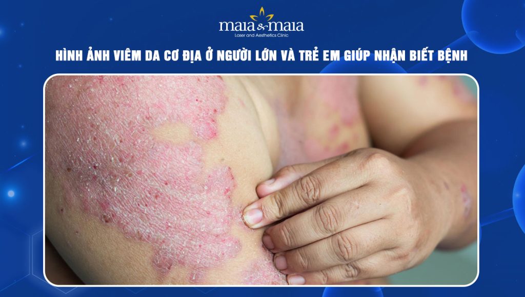 Tổng hợp hình ảnh viêm da cơ địa ở người lớn và trẻ em 1 hình ảnh viêm da cơ địa