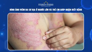 hình ảnh viêm da cơ địa