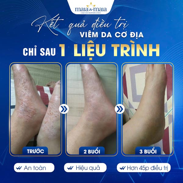 khách điều trị viêm da chân