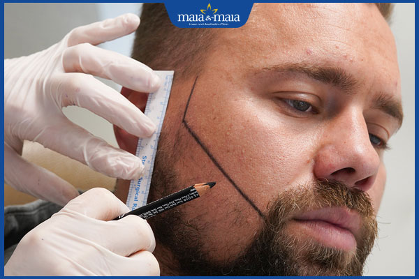 kỹ thuật cấy râu