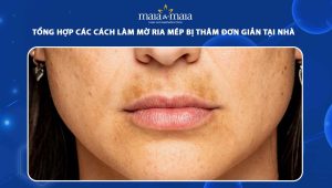 làm mờ ria mép bị thâm