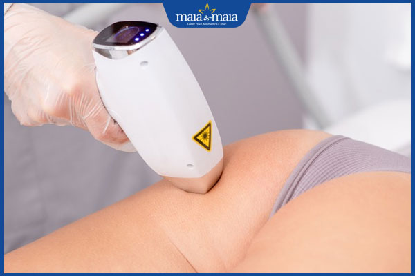 Có nên triệt lông hậu môn không? Phương pháp nào hiệu quả? 4 laser triệt lông hậu môn