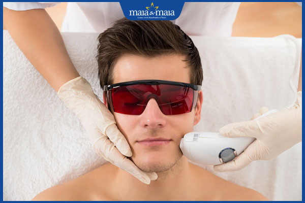 laser triệt ria mép nam