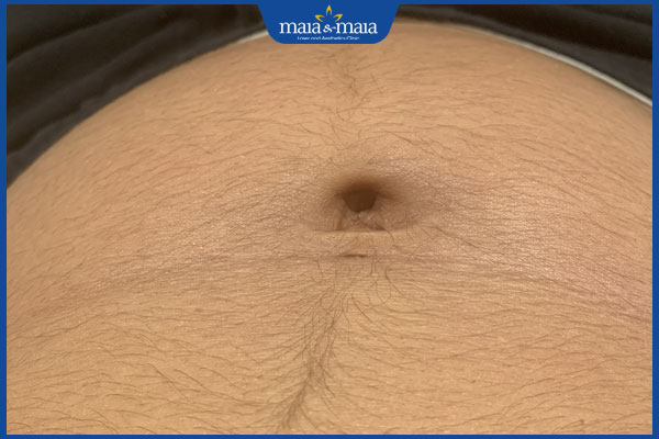 lông bụng mọc nhiều khi mang thai