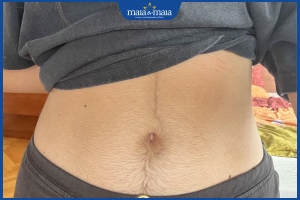 Triệt lông bụng: Giải pháp lâu dài, an toàn và hiệu quả cao 2 lông bụng ở con gái