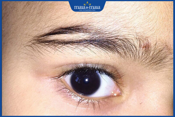 lông mày đứt đoạn tự nhiên